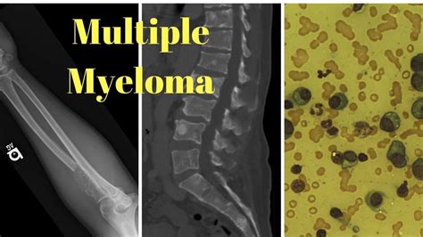 multiple myeloma final stages